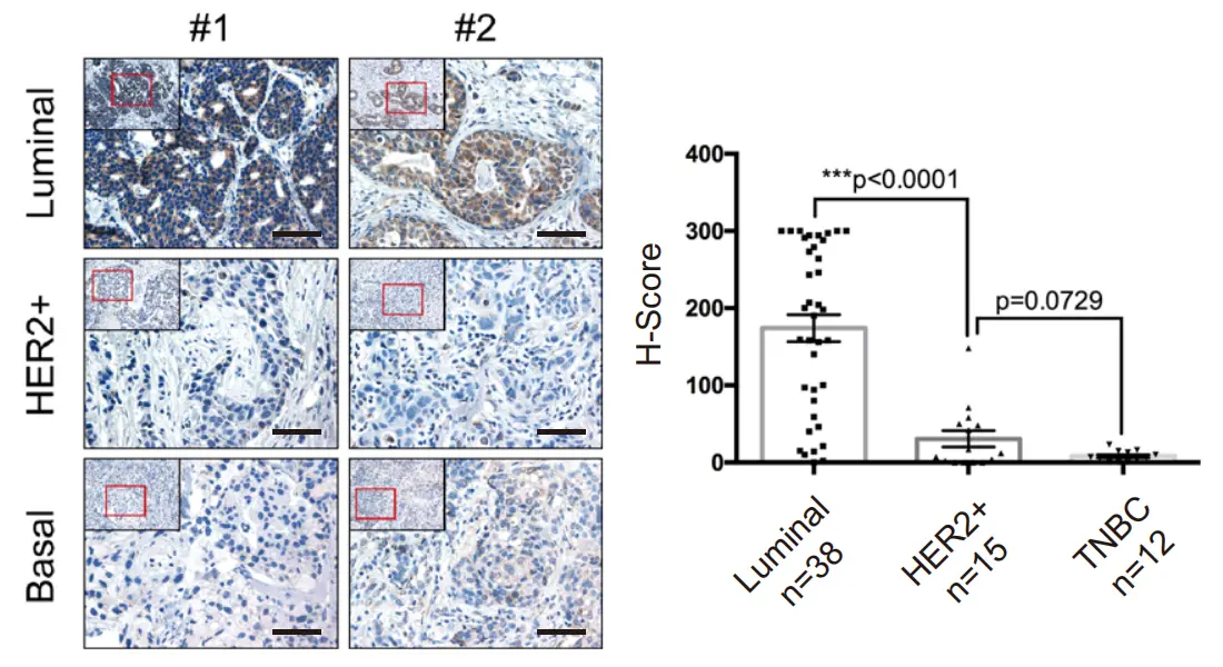 Figure_5._Immunohistochemical_analysis_of_ASB10_protein_expression_in_clinical_breast_cancer_tissues.webp