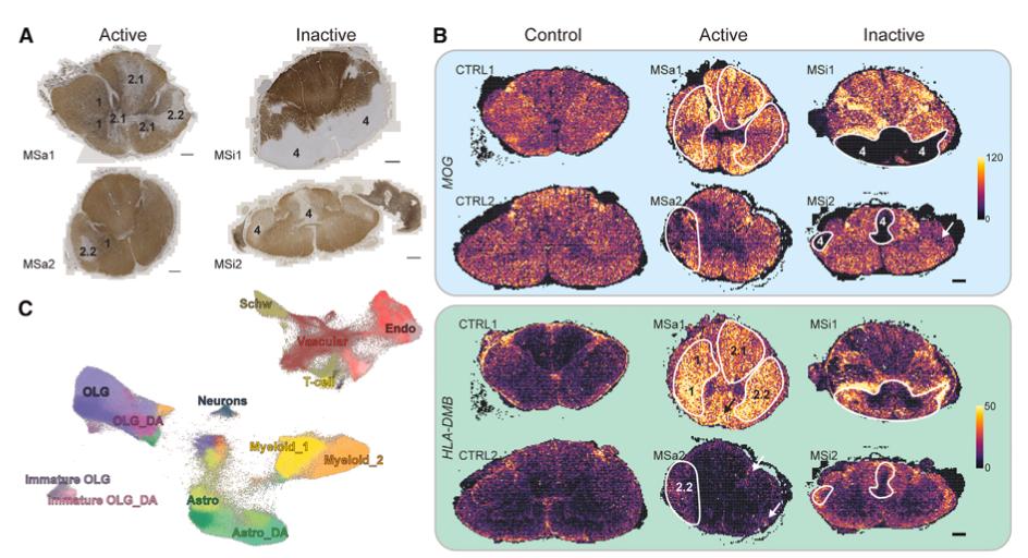 figure-2-spatial-distribution-of-disease-associated-da-glial-cells-in-ms-lesions.jpg